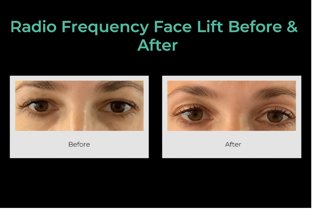 Radio frequency face lift in Southampton